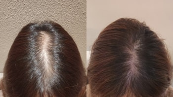 5회차 치료 전, 치료 후