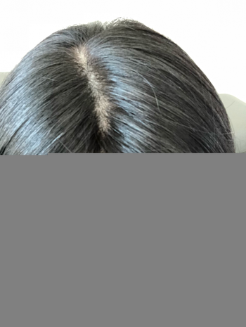 위에서 볼때 헤어라인 경계부위가 조금 티나는거 같아서 저부분은 헤어 쉐도우로 좀 가려줘야 할거 같아요 