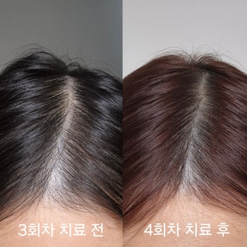 중간에 염색을 해서 머리 색이 바꼈지만 CHECK 주사 두피 치료랑 바르는 약 외에 다른 건 안했어요! 