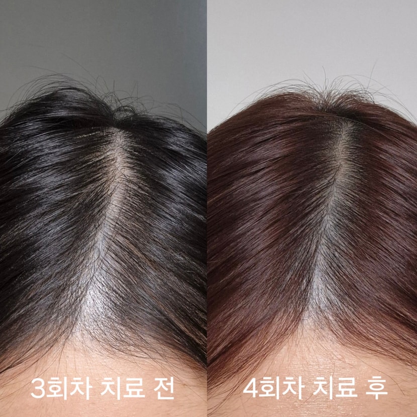 중간에 염색을 해서 머리 색이 바꼈지만 CHECK 주사 두피 치료랑 바르는 약 외에 다른 건 안했어요! 