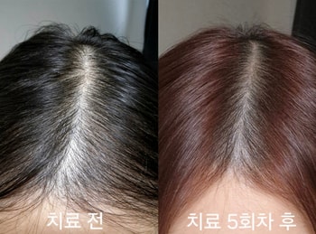치료 전후 사진입니다 (치료 중간에 염색을 해서 머리색만 다릅니다!)