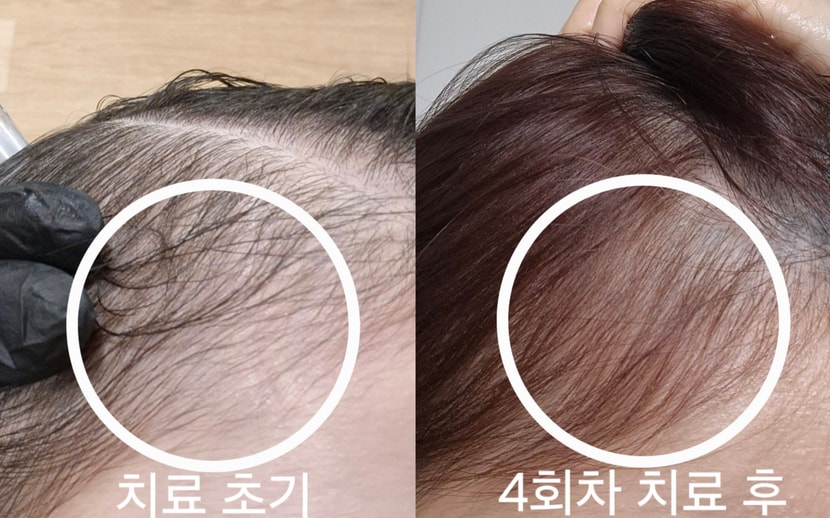 치료 전후 비교 사진 보여드립니다