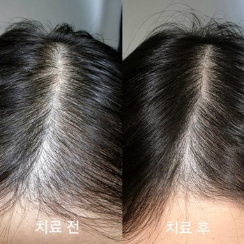 CHECK 주사 치료 시작전과 치료 후 사진입니다(비교를 위해 최대한 비슷하게 밝기 조절했습니다)