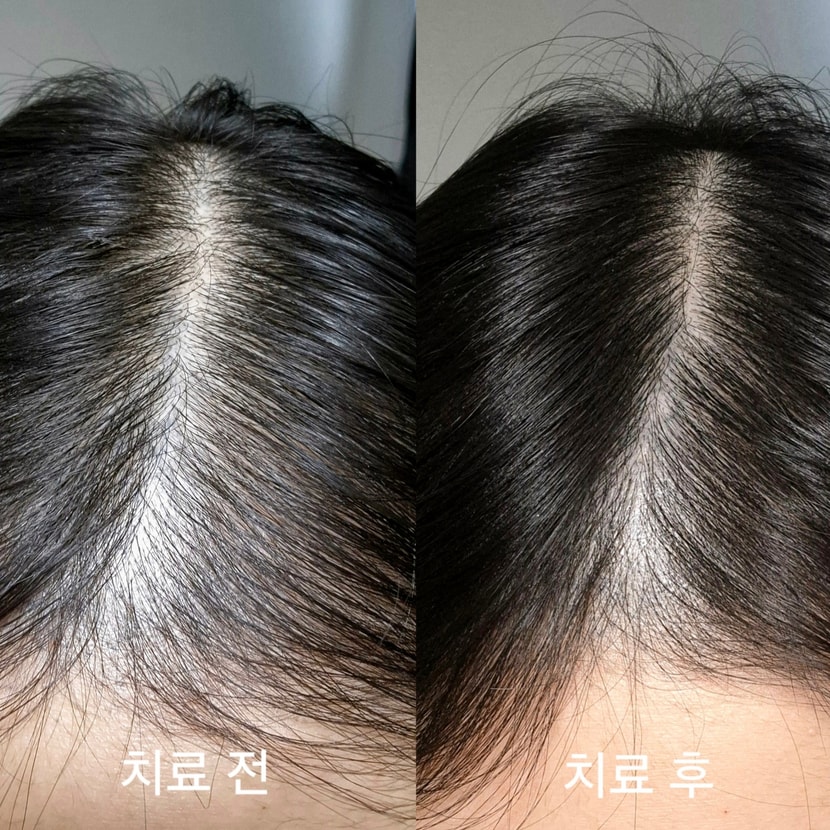 CHECK 주사 치료 시작전과 치료 후 사진입니다(비교를 위해 최대한 비슷하게 밝기 조절했습니다)