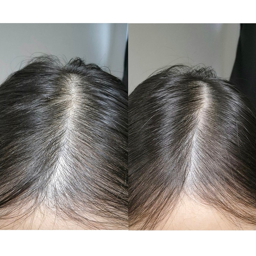 (위쪽은 CHECK주사 2회차 치료 후 사진입니다)아래 왼쪽은 두피 치료 전과 오른쪽은 CHECK 주사 1회차 후 모발 사진입니다