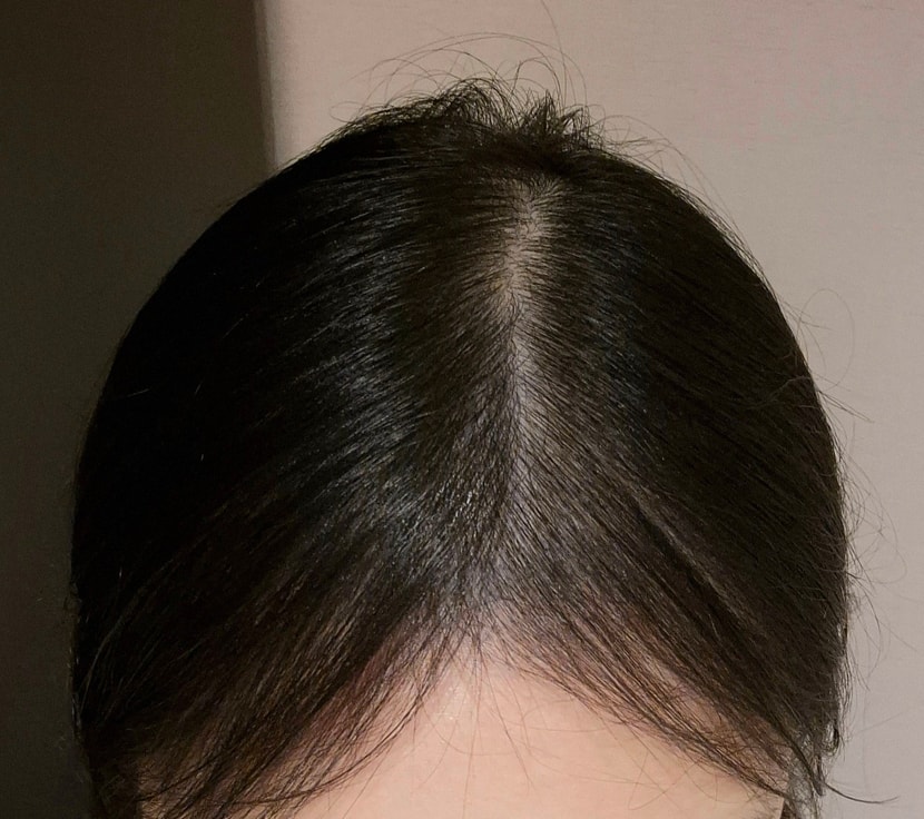 CHECK 주사 2회차 치료 후 모발 사진 입니다