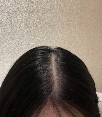 이 사진은 세번째 치료 후 사진 !! 두번째보다 더 채워진 것 같죠 ?! 사진보면 비포 에프터가 진짜 확실한 것 같아서 치료받길 너무 잘한 것 같아요 !! 