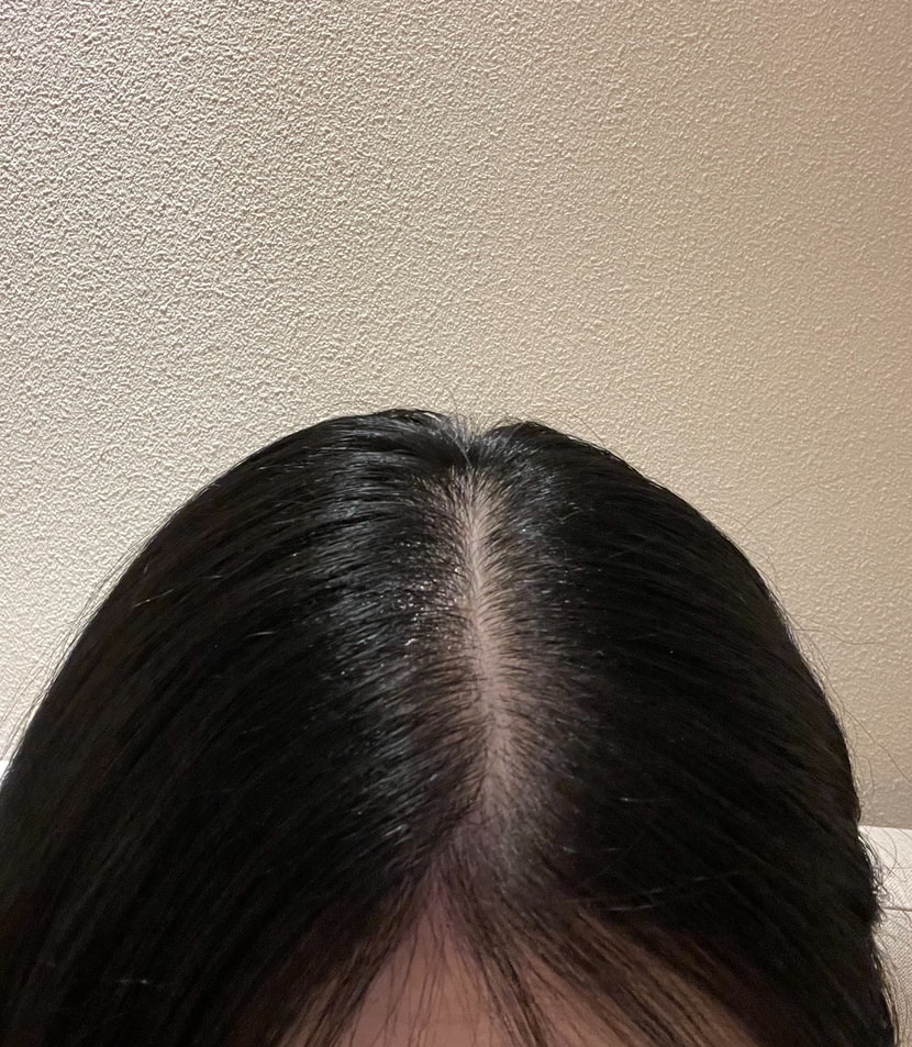 이 사진은 세번째 치료 후 사진 !! 두번째보다 더 채워진 것 같죠 ?! 사진보면 비포 에프터가 진짜 확실한 것 같아서 치료받길 너무 잘한 것 같아요 !! 
