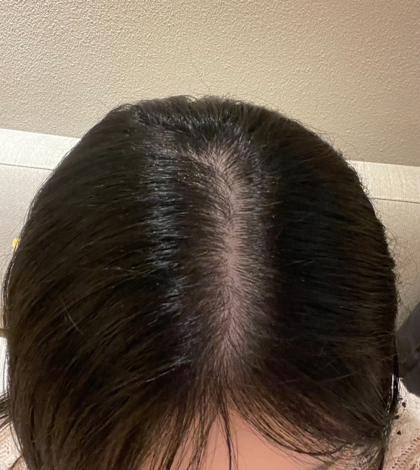 요사진은 ! 두번째 치료 후 사진 .. !! 확실히 처음보다 정수리가 채워졌지 않나요 ?! 확실히 헤어온의원 다니고부터 정수리에 대한 스트레스가 확 줄었어요 !! 