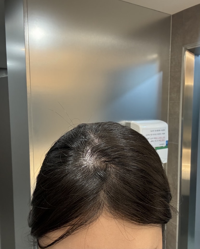 탈모 맞죠?? 댓글 부탁드려요 ㅜㅜ