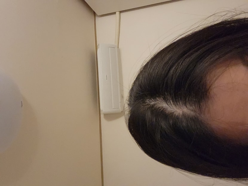 두피사진
