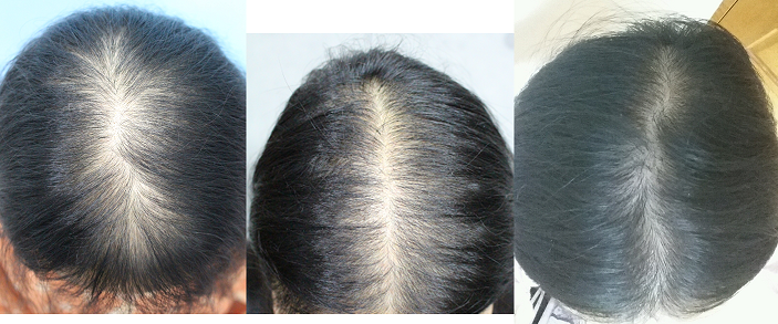 수술 당일, 5개월차, 9개월차 정수리샷