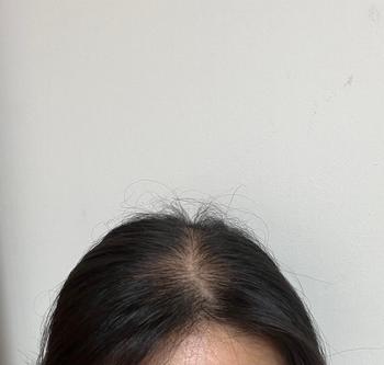 시술전