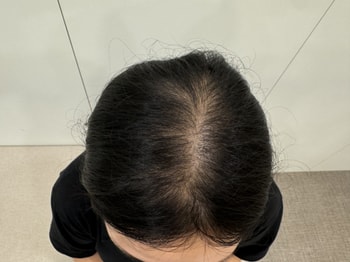 3주차 시술전 사진이에요.