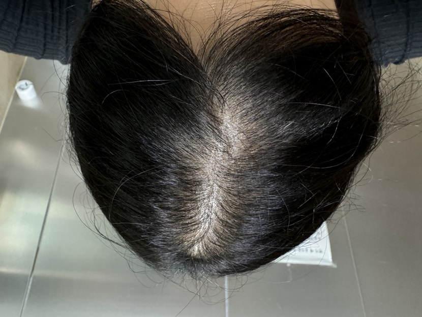 3주차 시술 후 사진이에요!