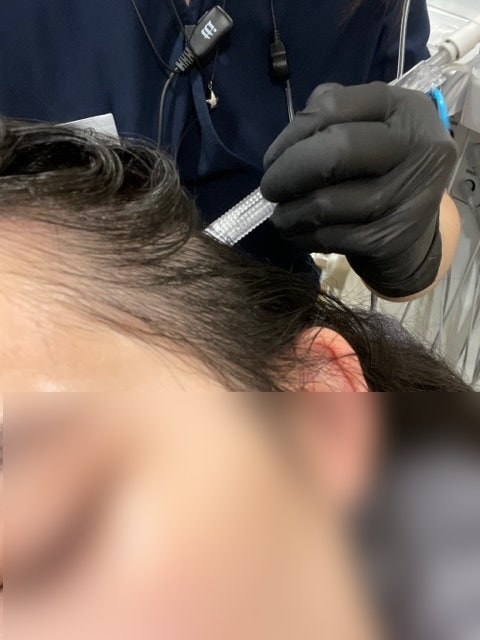 두피스케일링 후 산소제트필 과정