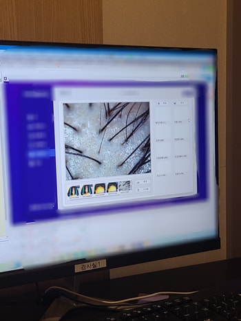 예상은 했지만 이렇게 검사하면서 직접 보니까 충격이더라구요 더 빨리올걸 후회했어요 ㅠㅠ  이제 진료 타임.. 의사선생님이 이것저것 친절하게 많이 물어봐주셨어요 저는 어깨통증이랑 두통이 심한편인데 두통이 심하면 두피가 긴장해서  탈모가 올 수 있다고 하더라구요 ㅠㅠ 