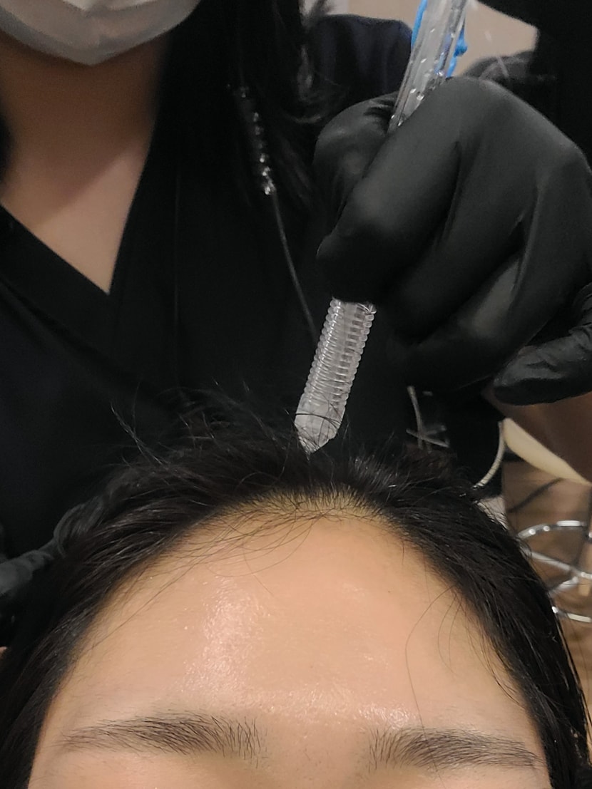 제일 중요한 체크주사! 니들로 미세한 상처를 내서 약물을 투입하는데 니들 강도를 조절할 수 있어서 좋더라구요 아프지않게 잘 받았어요