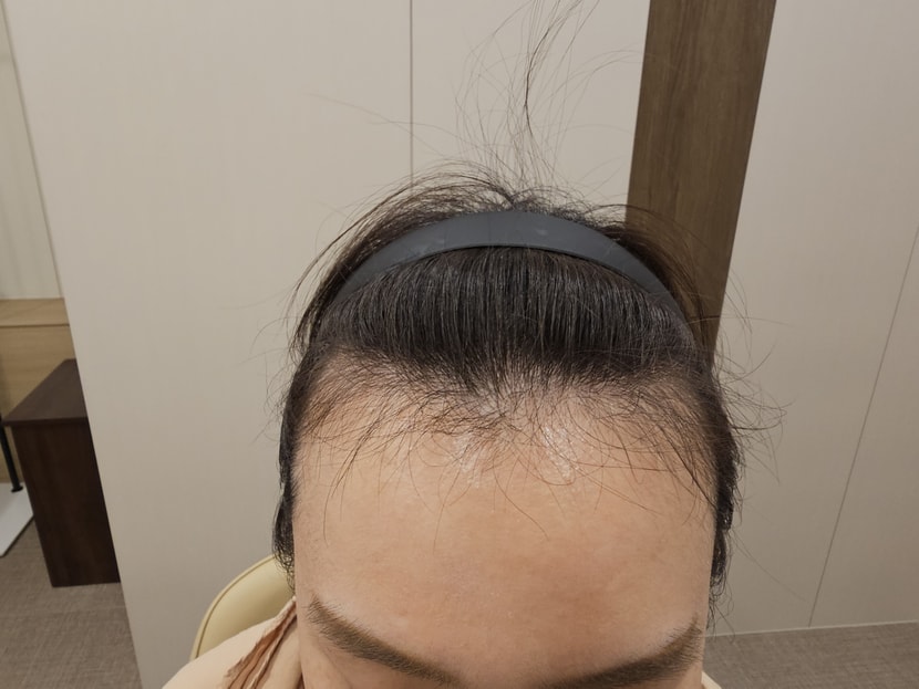 M자 탈모 치료전 상태