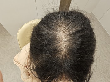 정수리 치료 전