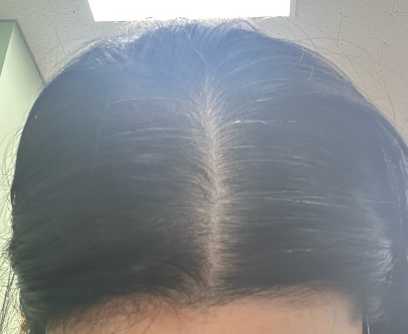 2회차 시술후 6일차(일반빛)