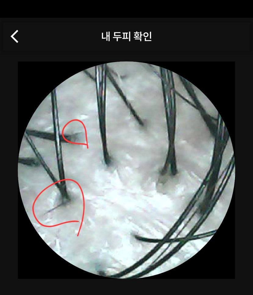 3주 후 두피상태 2