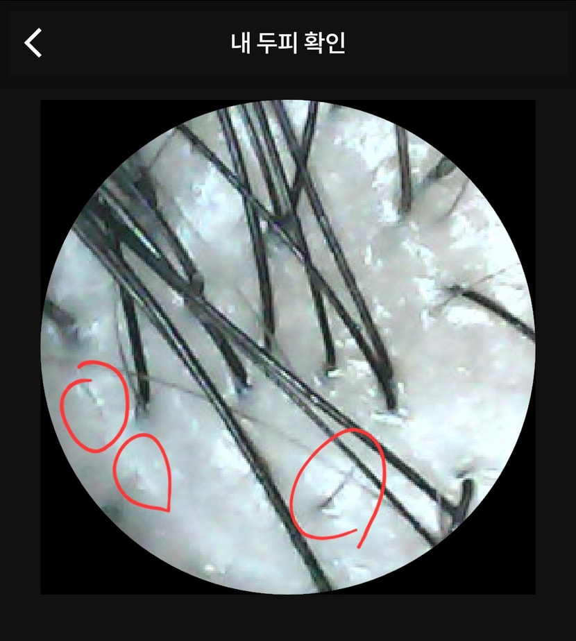 3주 관리 후 두피상태