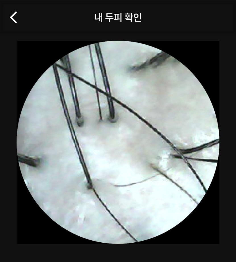 시술 3일후 집에서 찍은 두피상태 