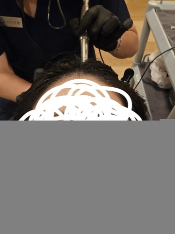 두피에 구멍? (상처)을 내고