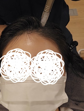 체크주사- 두피에 구멍낸후 앰플주입