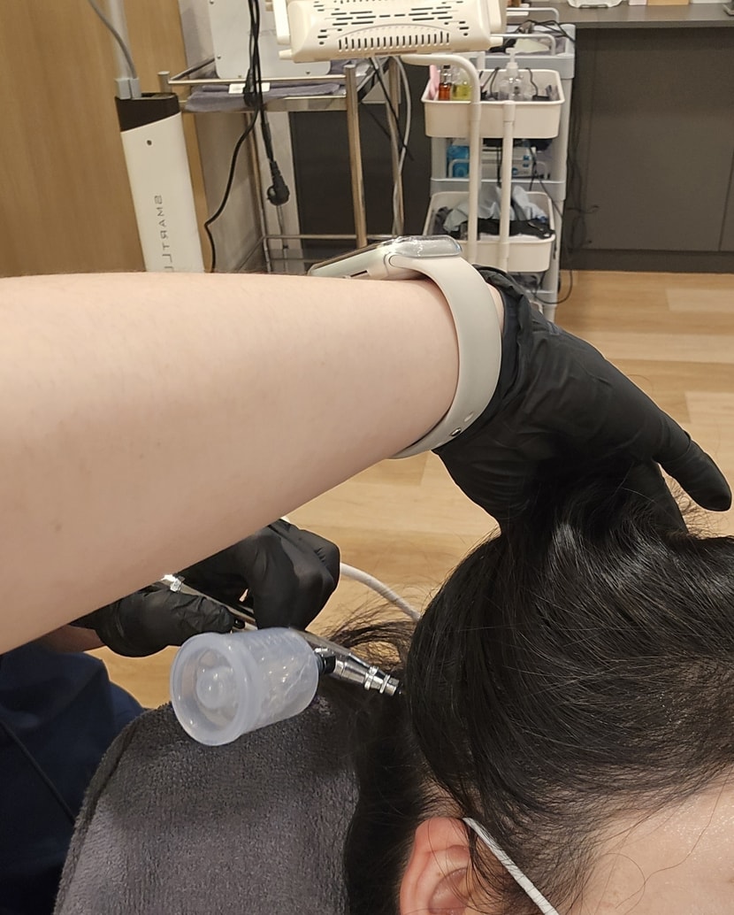 스케일링- 각질연화제 작업