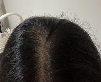 탈모치료 6회차