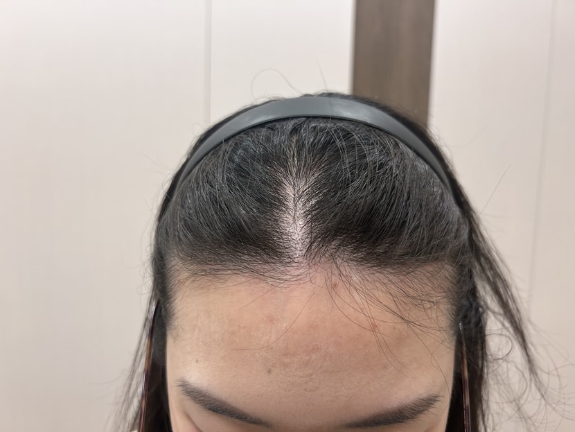 치료후