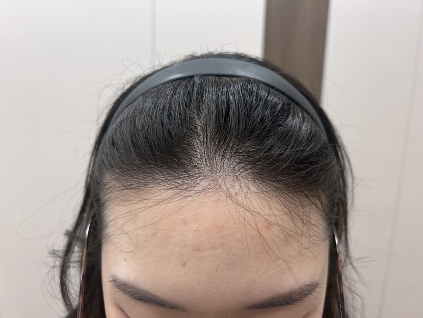 치료전