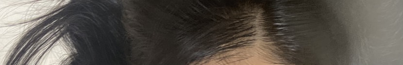 점점 휑해지는 앞쪽머리..