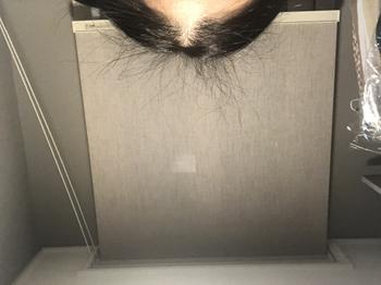 먹는 미녹 4개월 후 잔머리 사진