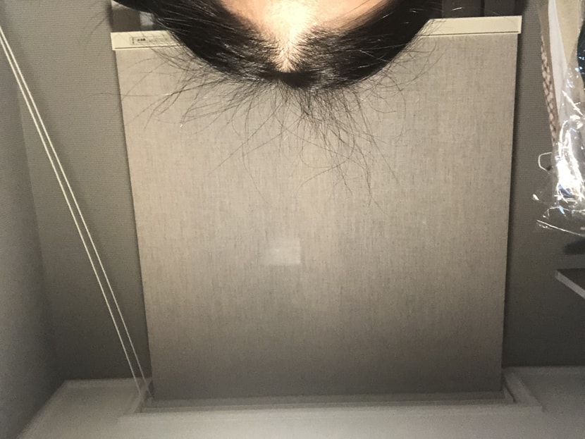 먹는 미녹 4개월 후 잔머리 사진