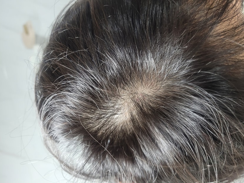 치료전두피상태