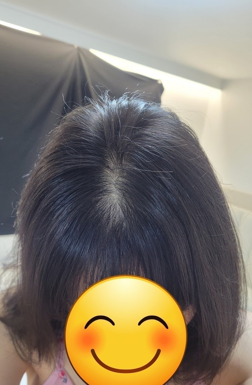 두피샷 확실히 울긋불긋한게 많이 들어갔다 