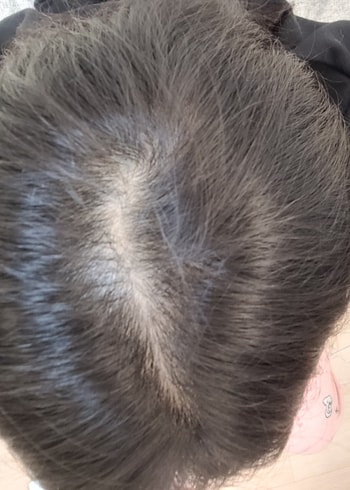 두피상태도 많이 깨끗해졌고 모근에 힘이생김