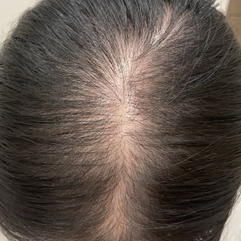 3회차 시술 직후