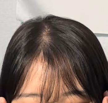 지인이 찍어준사진 (치료전)