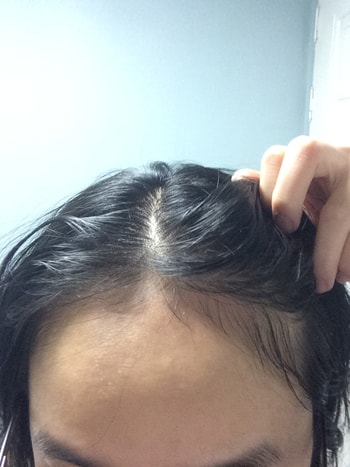 오늘 메조 받고 왔어요 오늘까지 총 15회차 입니다 ㅎ