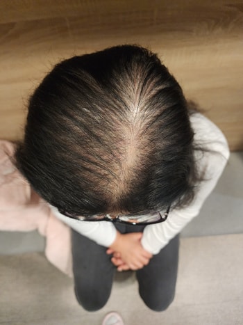 치료 후 사진