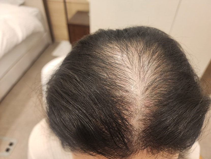 1회차 치료 후 두피사진