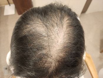 치료 전 두피상태