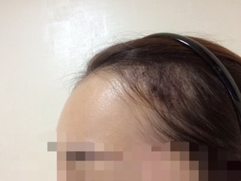수술후왼쪽!