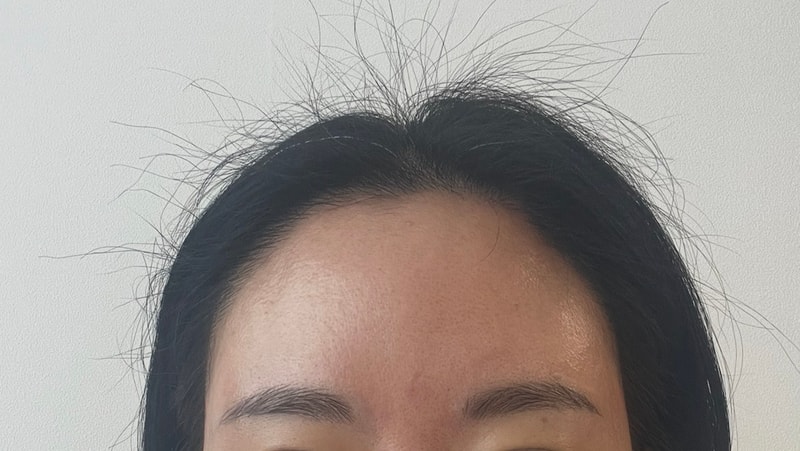 (모제림 이원석 원장님)이마거상후 모발이식 6개월됐어요