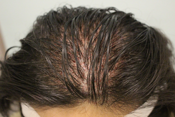 수술 끝나고인데 생각보다 출혈이나 통증은 적었어요