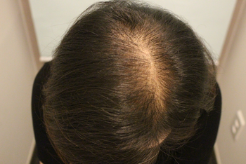 수술하고 4개월 째 모습입니다